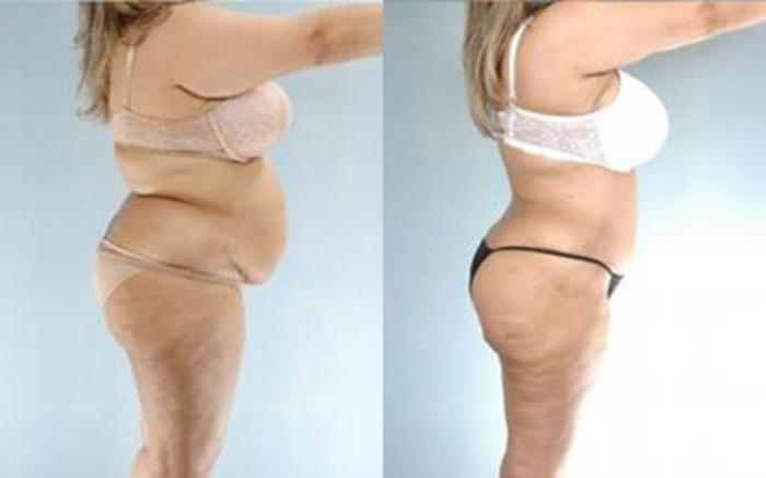 Before & After Tummy Tuck Case 61 View 3 View in Houston, TX