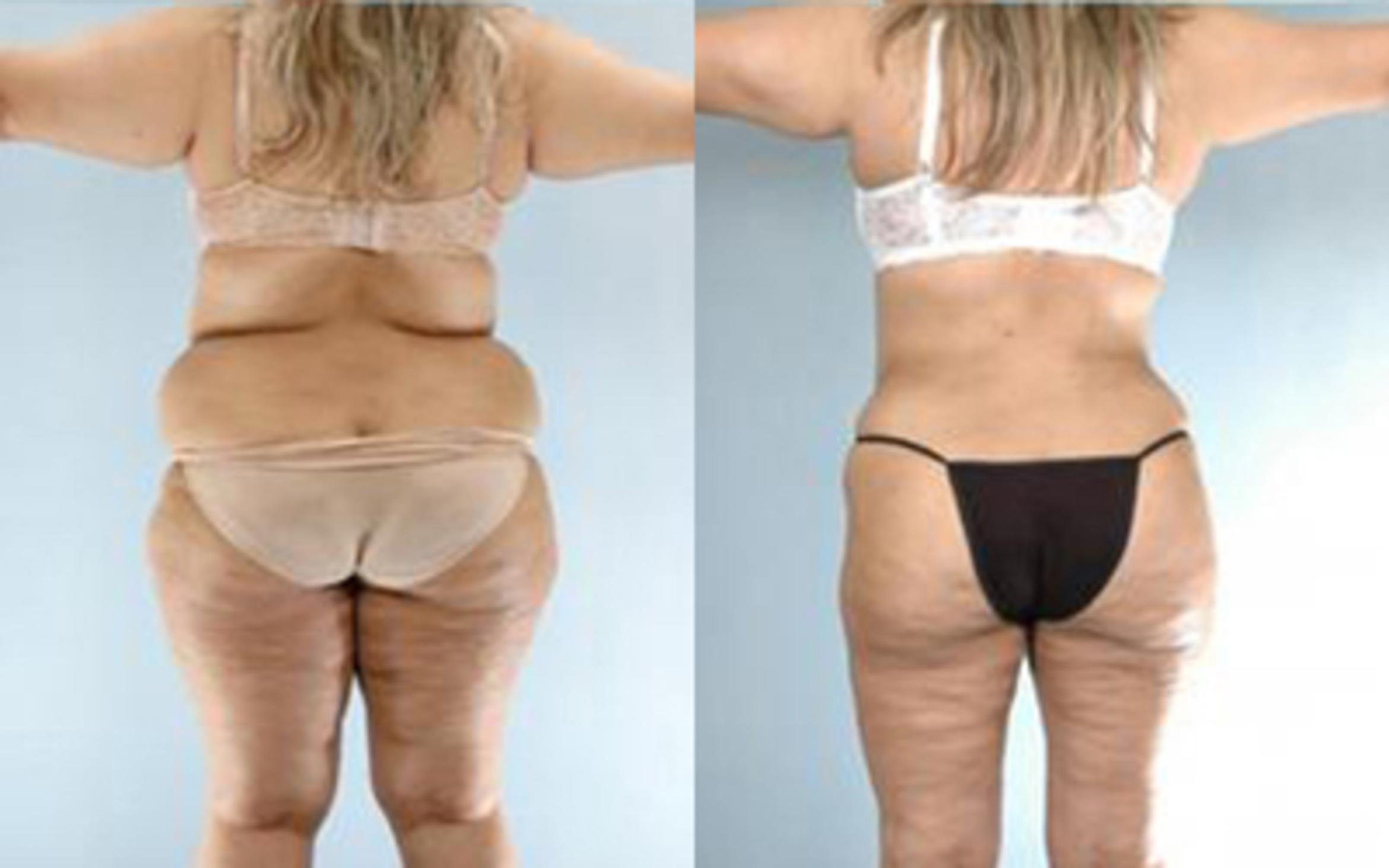 Before & After Tummy Tuck Case 61 View 4 View in Houston, TX
