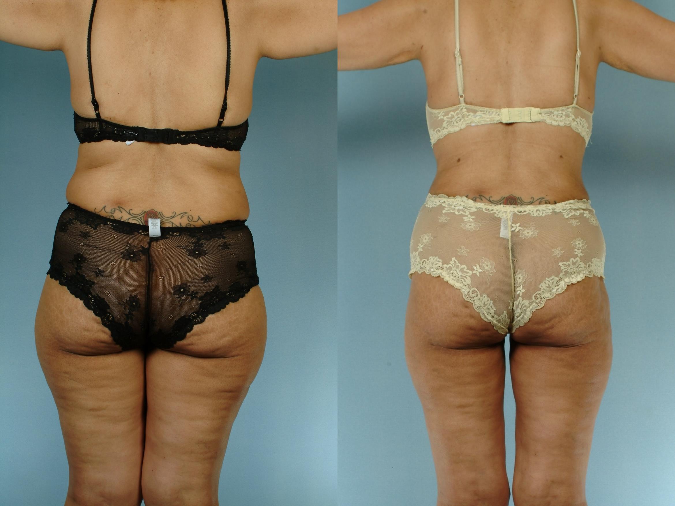 Before & After Liposuction Case 613875210003 Back View in Houston, TX