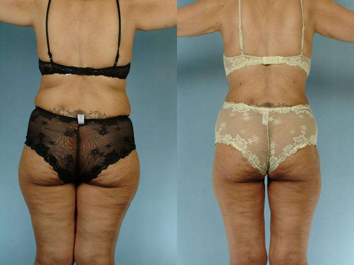 Before & After Liposuction Case 613875210003 Back View in Houston, TX