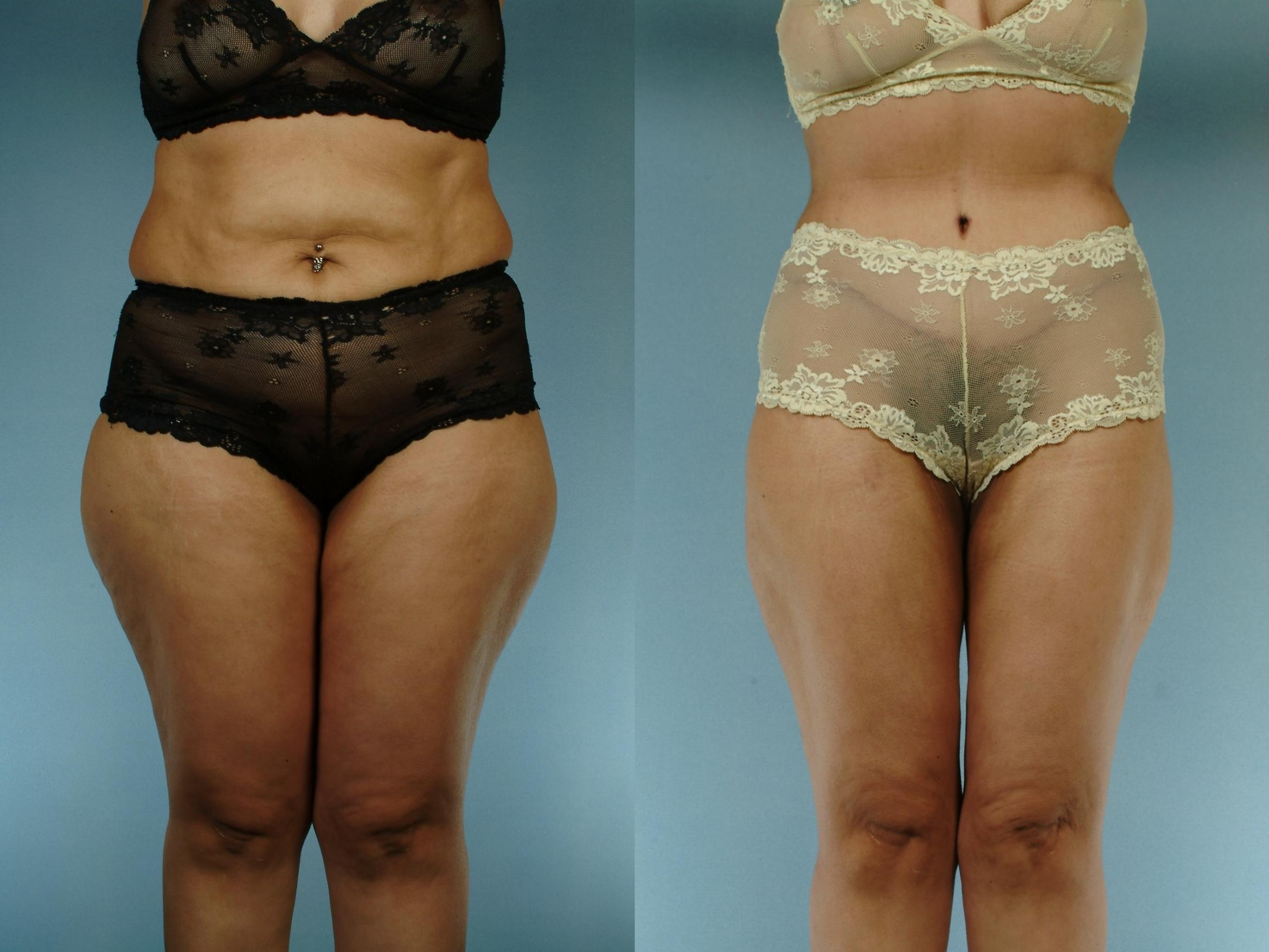 Before & After Liposuction Case 613875210003 Front View in Houston, TX