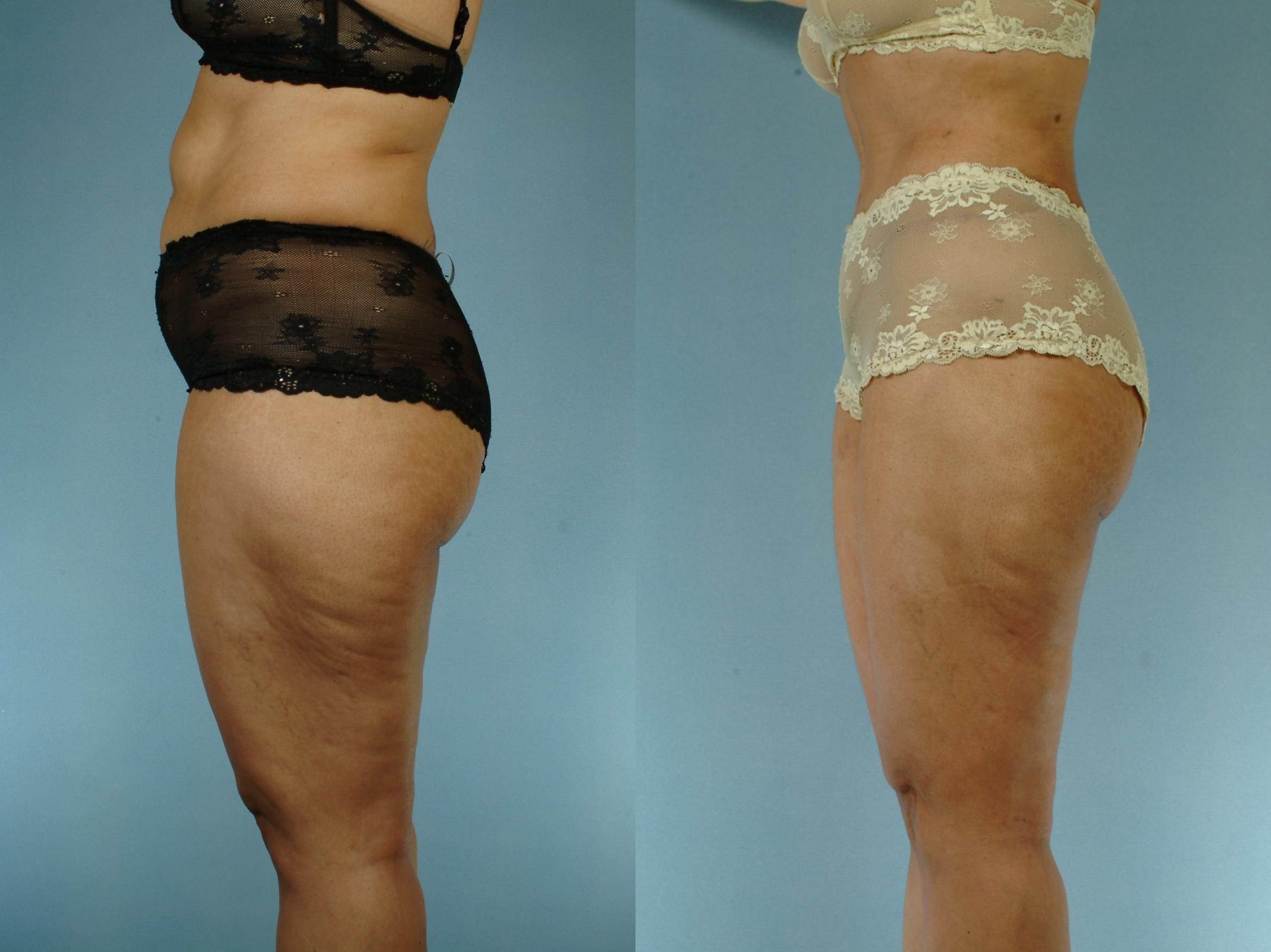 Before & After Liposuction Case 613875210003 Left Side View in Houston, TX