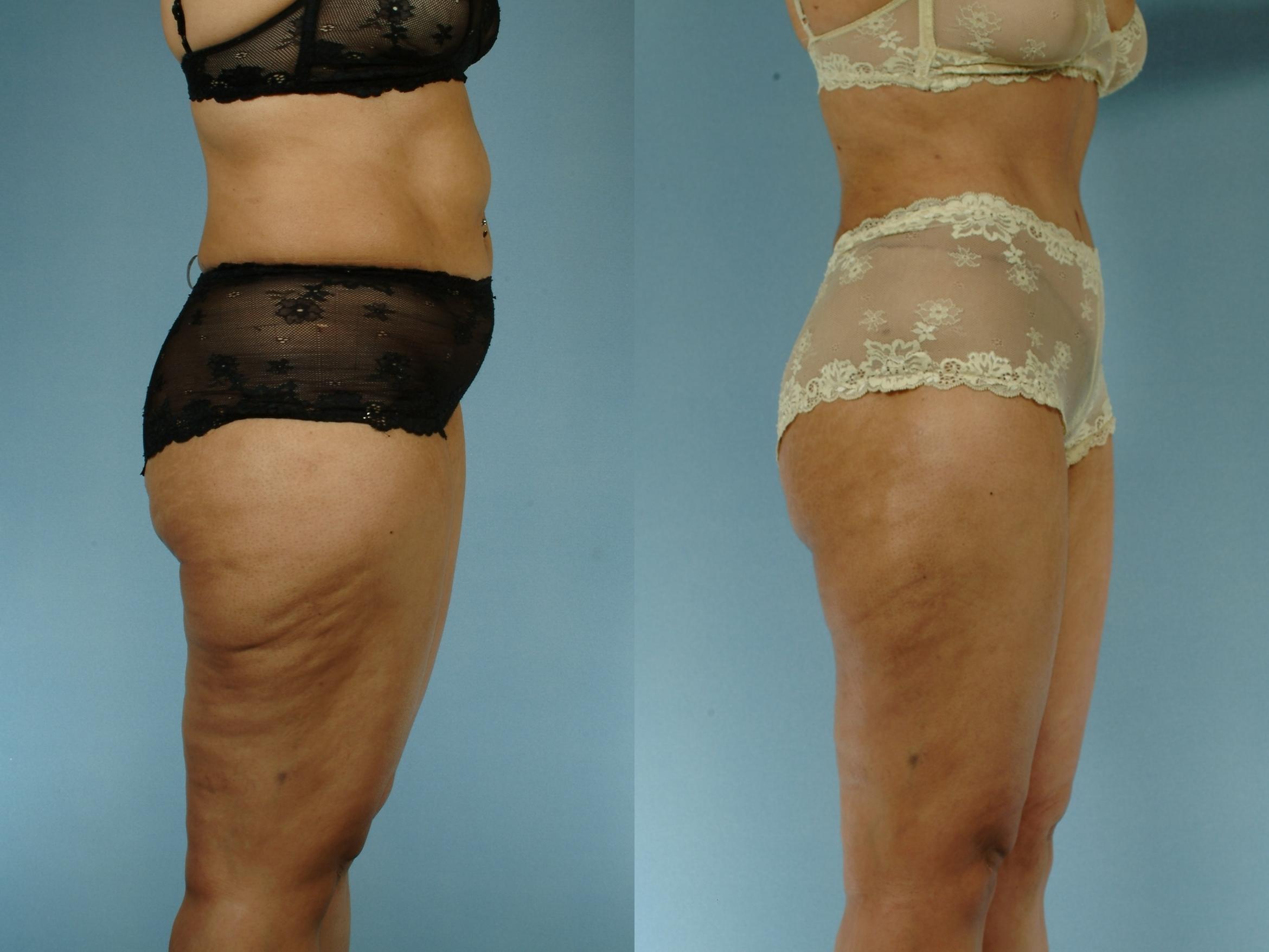 Before & After Liposuction Case 613875210003 Right Side View in Houston, TX