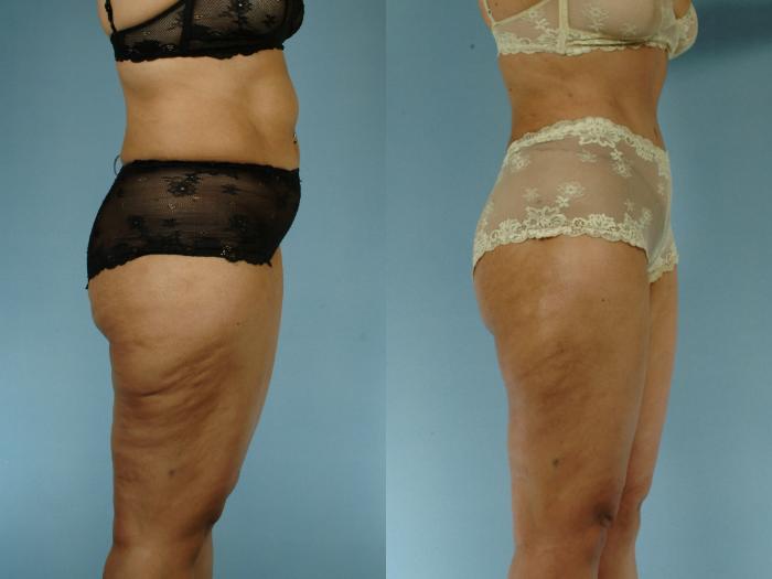 Before & After Liposuction Case 613875210003 Right Side View in Houston, TX