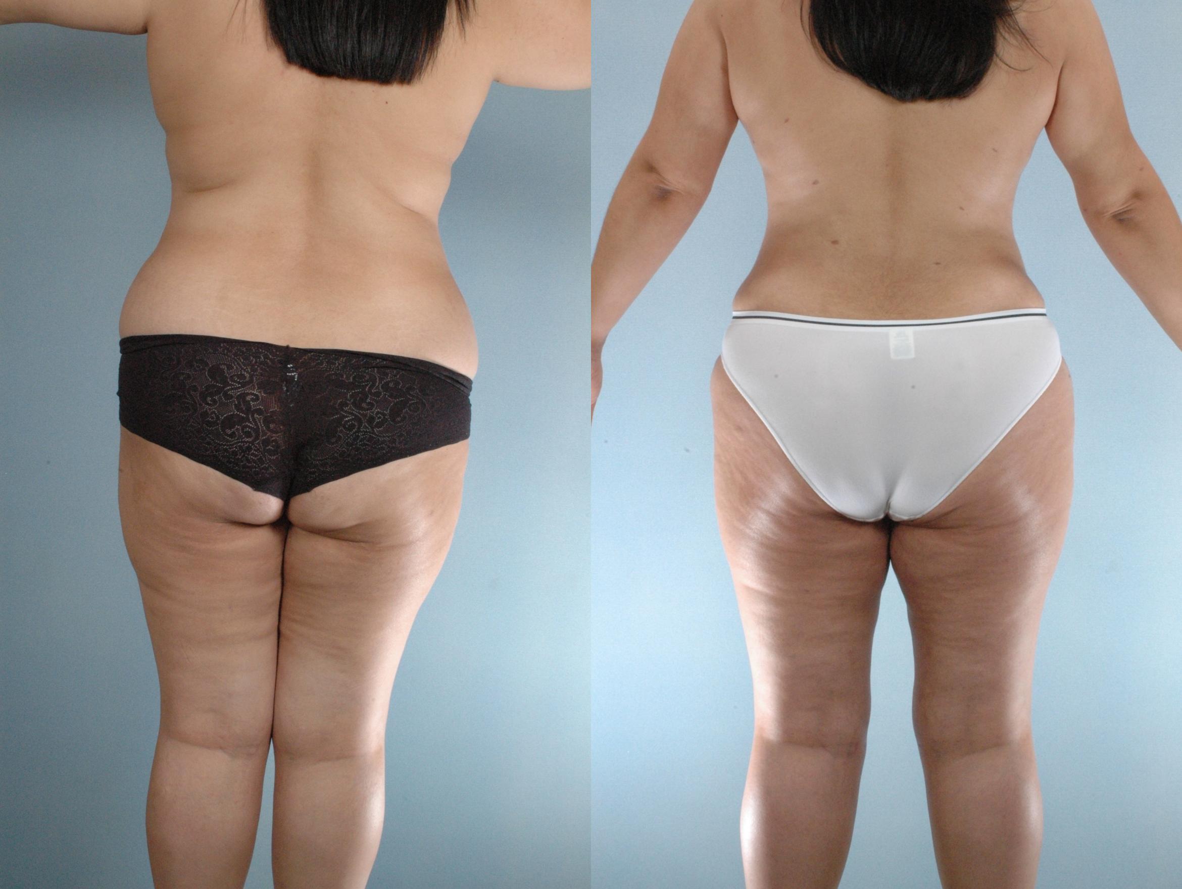 Before & After Liposuction Case 613875210005 Back View in Houston, TX