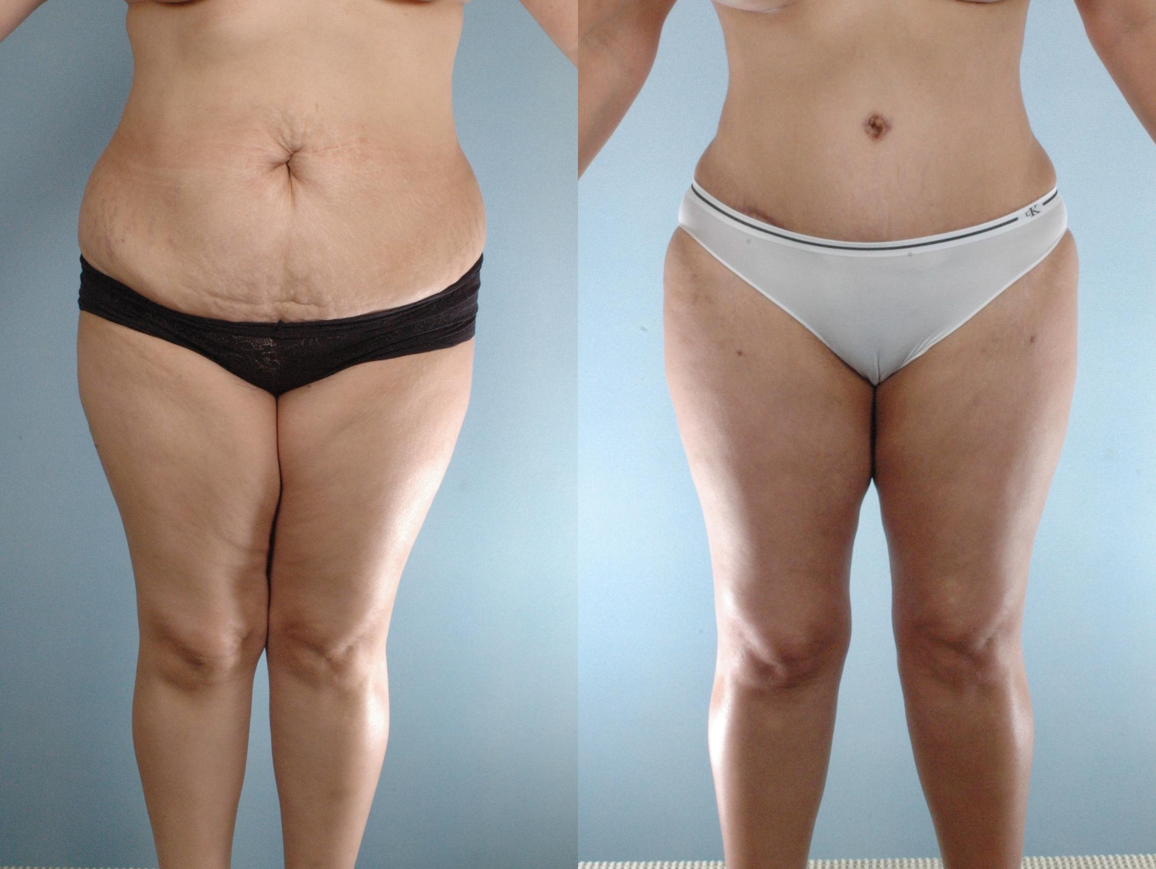 Before & After Liposuction Case 613875210005 Front View in Houston, TX