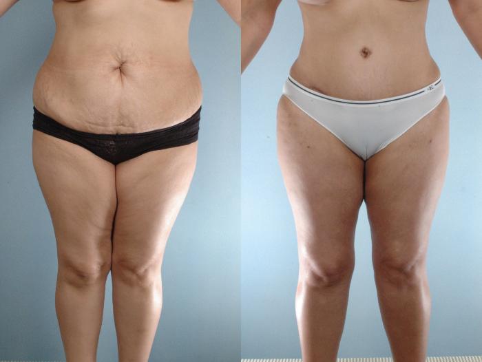 Before & After Liposuction Case 613875210005 Front View in Houston, TX