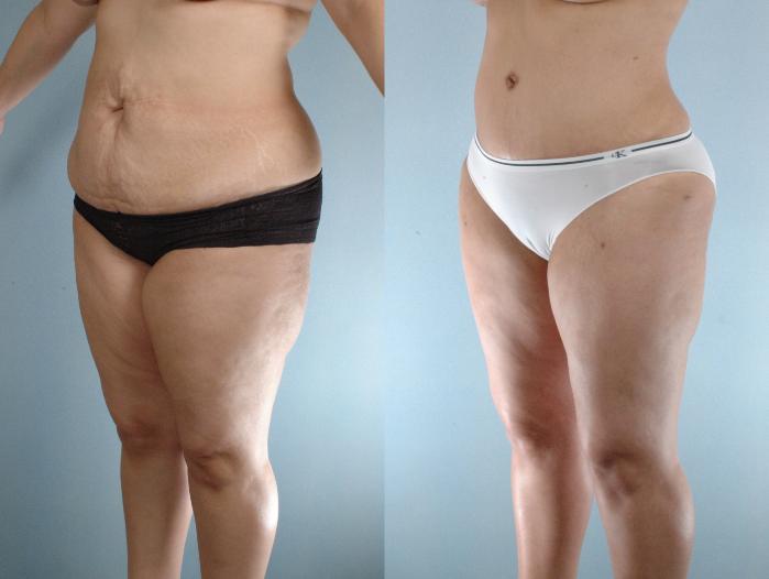 Before & After Liposuction Case 613875210005 Left Oblique View in Houston, TX