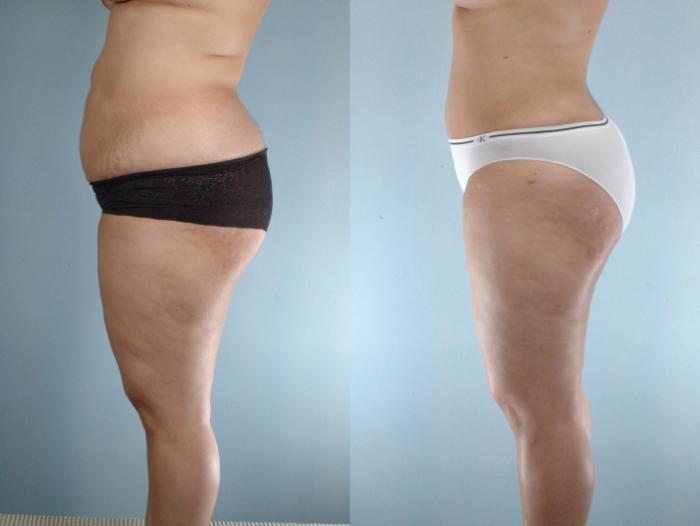 Before & After Liposuction Case 613875210005 Left Side View in Houston, TX