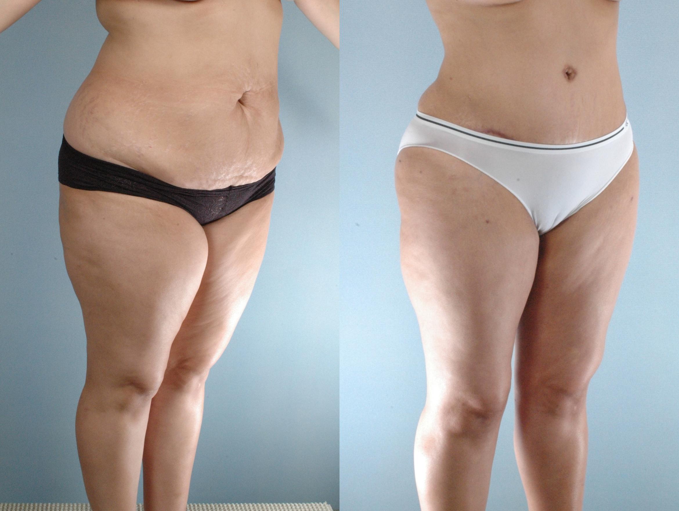 Before & After Liposuction Case 613875210005 Right Oblique View in Houston, TX