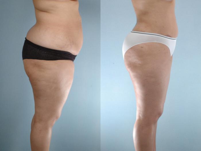 Before & After Liposuction Case 613875210005 Right Side View in Houston, TX
