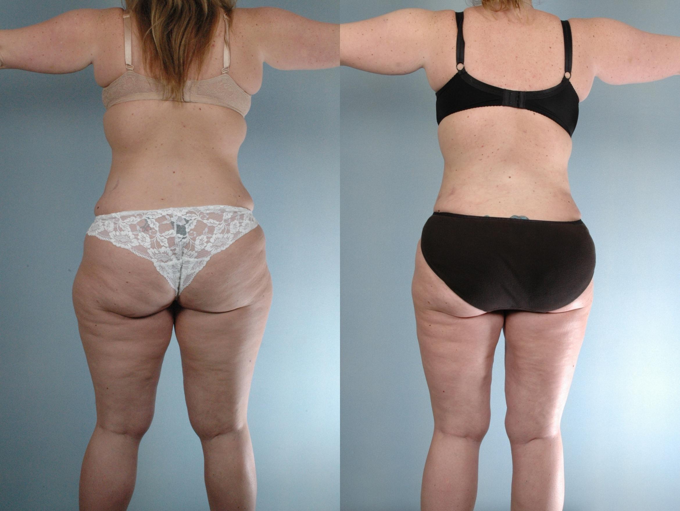 Before & After Tummy Tuck Case 613875210007 Back View in Houston, TX