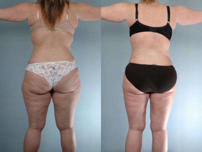 Before & After Tummy Tuck Case 613875210007 Back View in Houston, TX