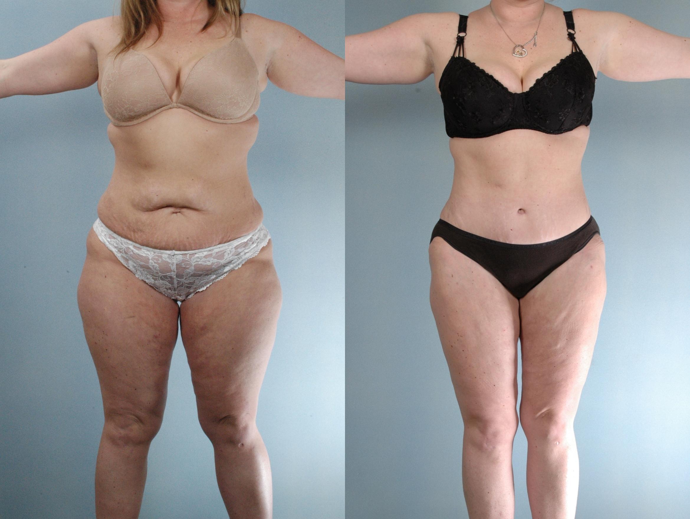 Before & After Tummy Tuck Case 613875210007 Front View in Houston, TX
