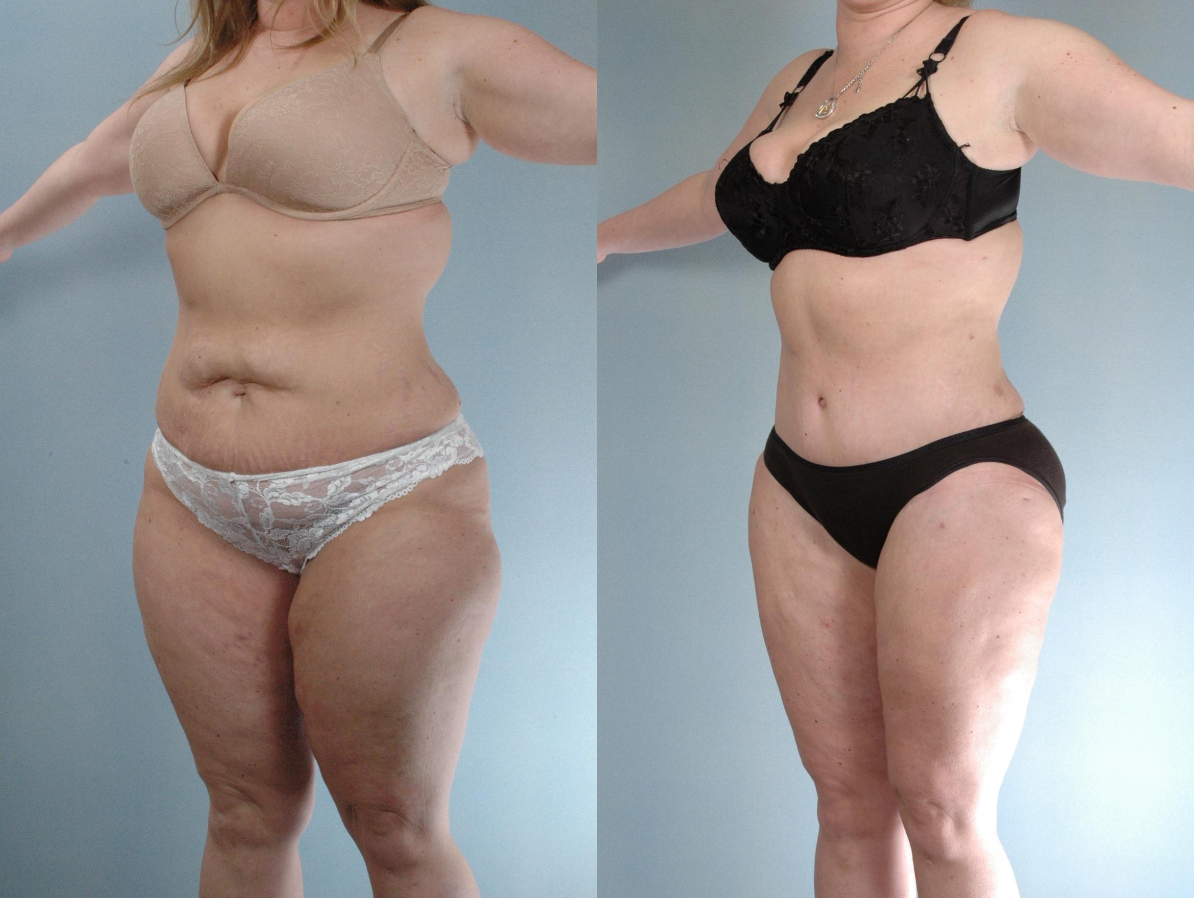 Before & After Tummy Tuck Case 613875210007 Left Oblique View in Houston, TX