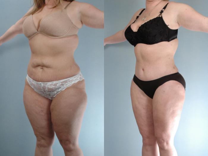Before & After Tummy Tuck Case 613875210007 Left Oblique View in Houston, TX