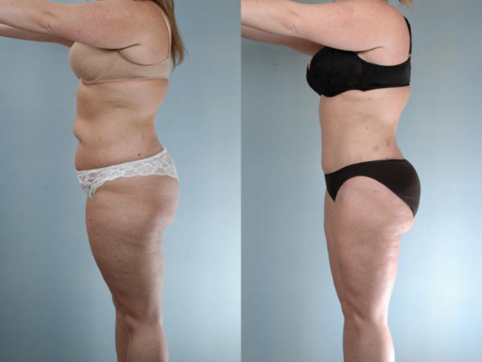 Before & After Tummy Tuck Case 613875210007 Left Side View in Houston, TX