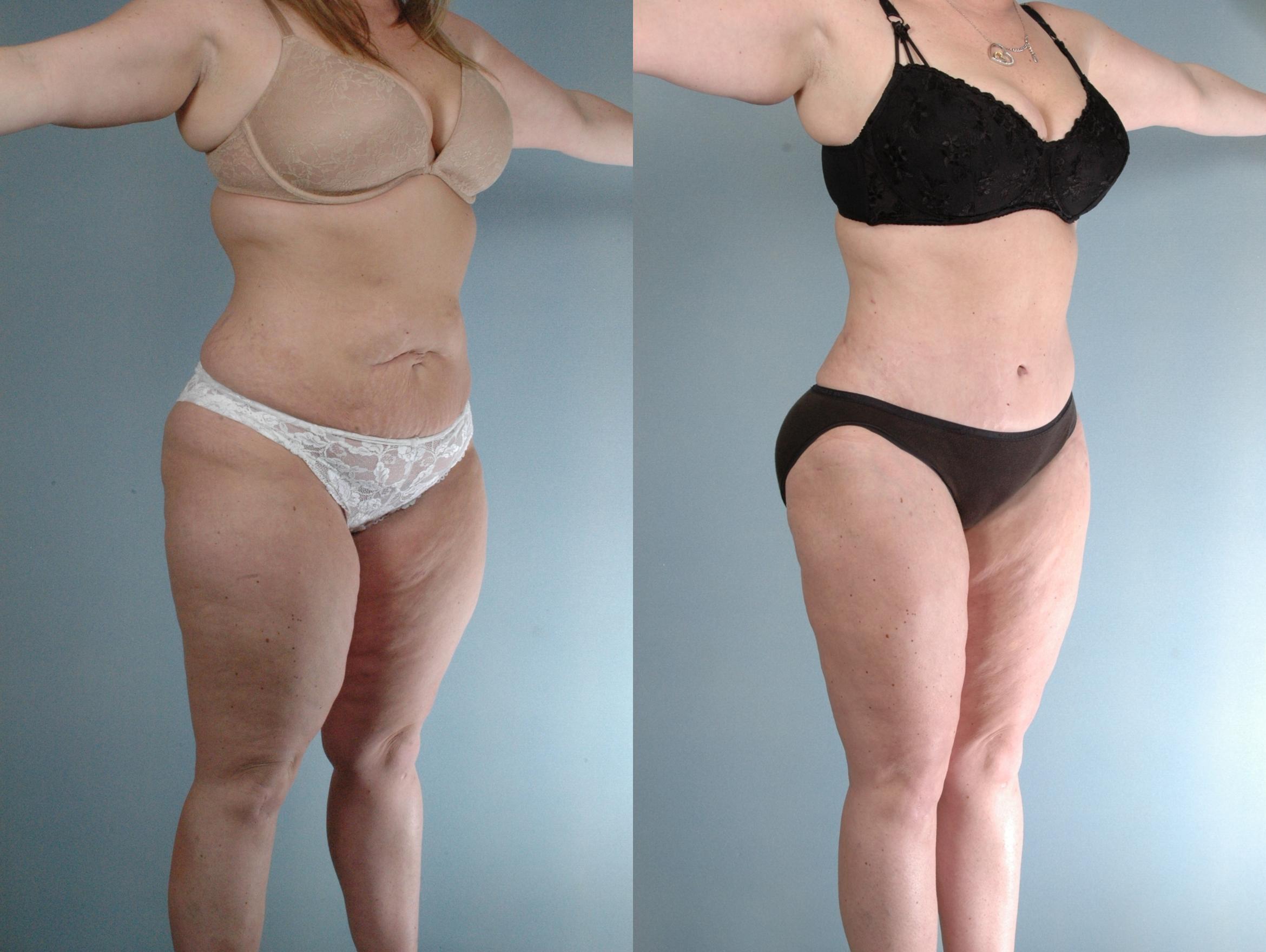 Before & After Tummy Tuck Case 613875210007 Right Oblique View in Houston, TX