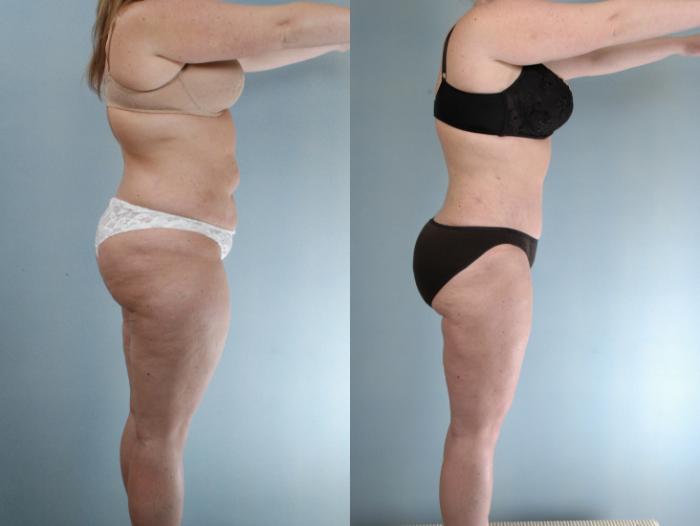 Before & After Tummy Tuck Case 613875210007 Right Side View in Houston, TX
