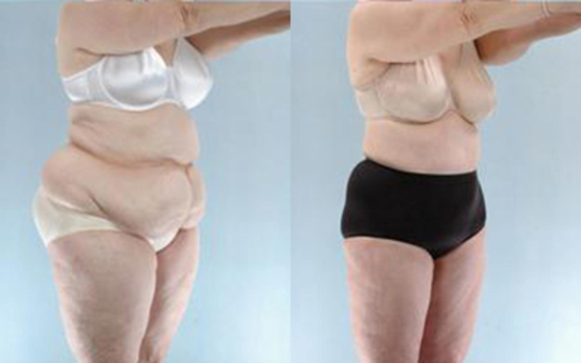 Before & After Tummy Tuck Case 62 View 2 View in Houston, TX