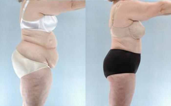Before & After Tummy Tuck Case 62 View 3 View in Houston, TX