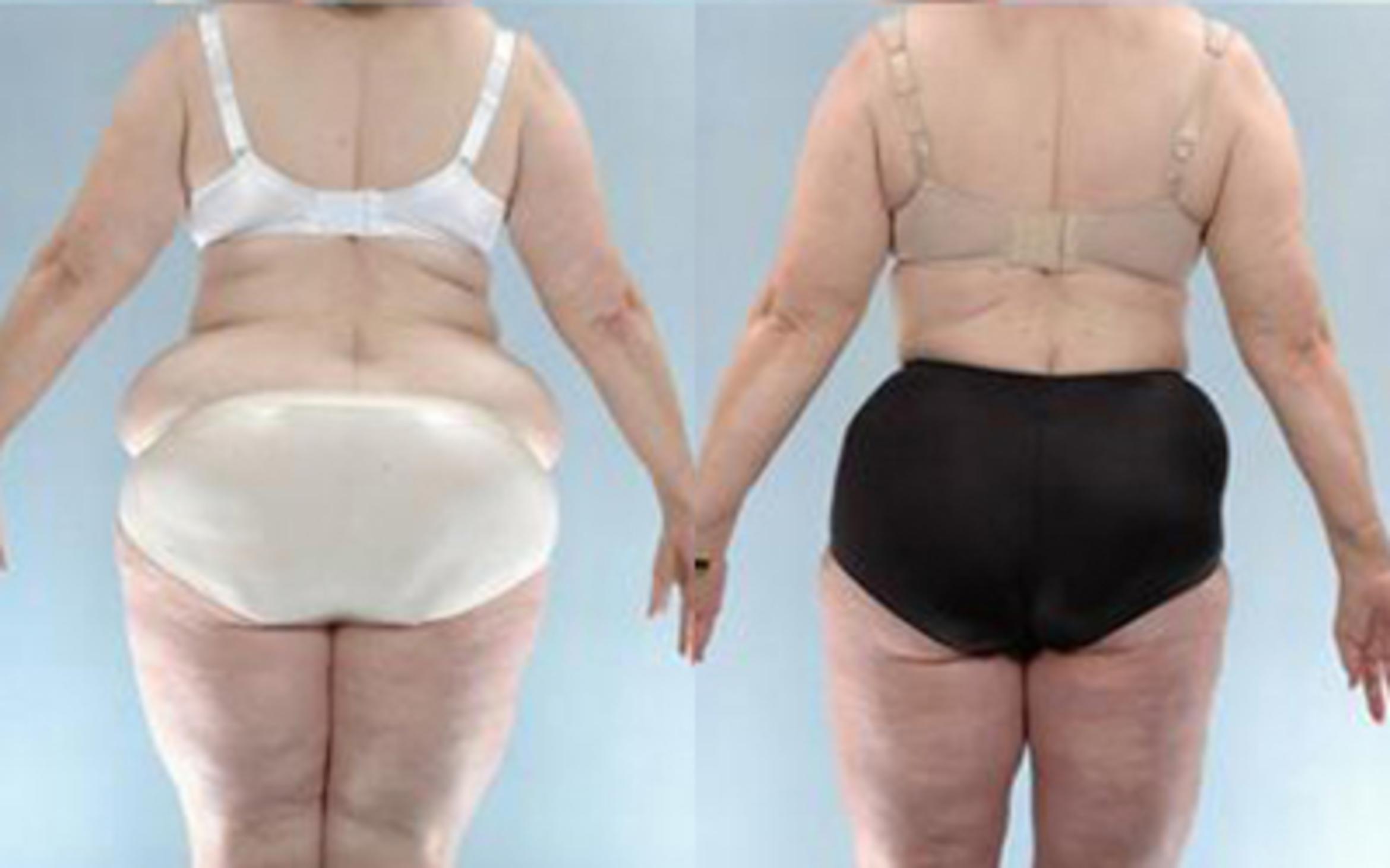 Before & After Tummy Tuck Case 62 View 4 View in Houston, TX