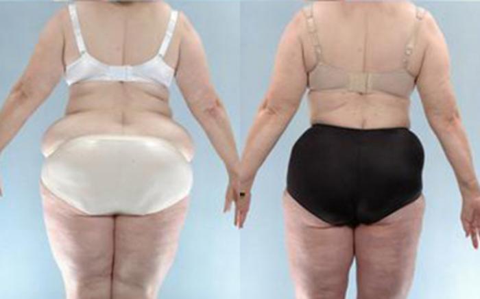 Before & After Tummy Tuck Case 62 View 4 View in Houston, TX