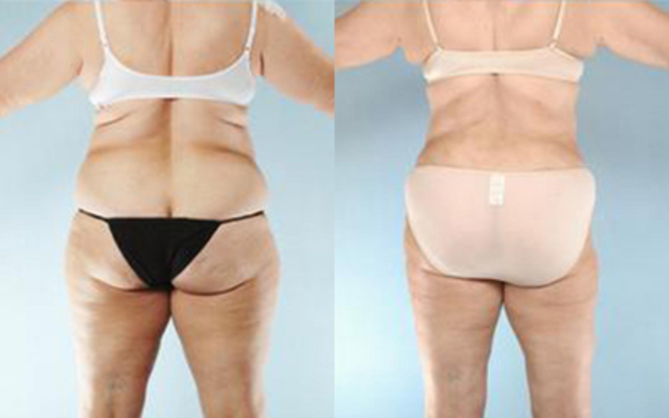 Before & After Tummy Tuck Case 63 View 4 View in Houston, TX