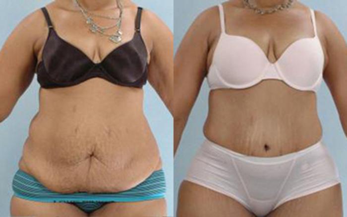 Before & After Tummy Tuck Case 64 View 1 View in Houston, TX
