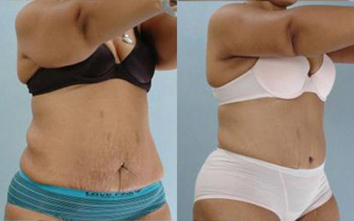 Before & After Tummy Tuck Case 64 View 2 View in Houston, TX