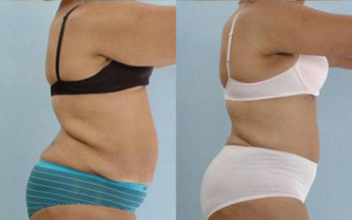 Before & After Tummy Tuck Case 64 View 3 View in Houston, TX