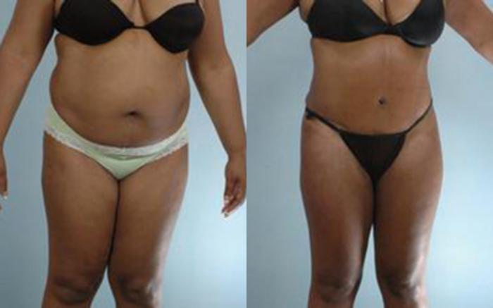 Before & After Tummy Tuck Case 65 View 1 View in Houston, TX