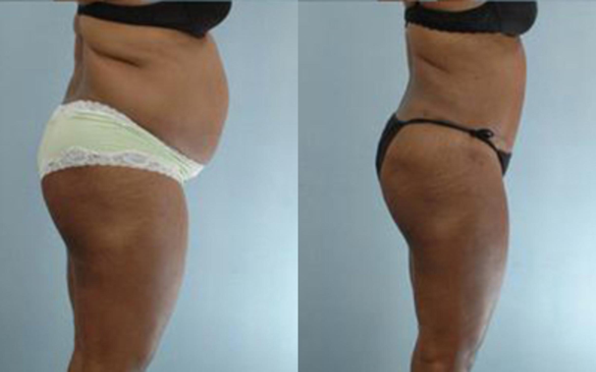 Before & After Tummy Tuck Case 65 View 3 View in Houston, TX