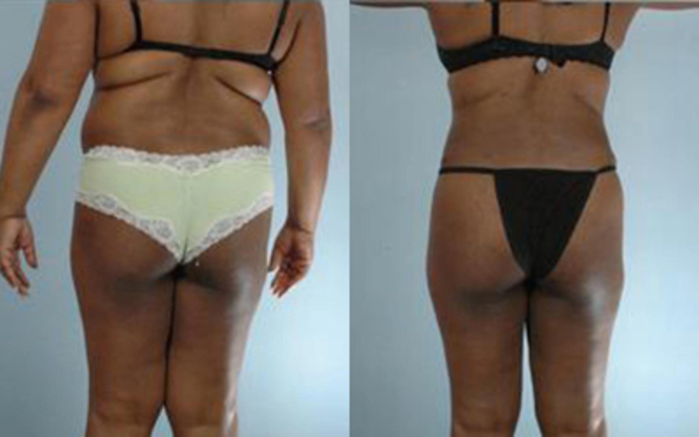 Before & After Tummy Tuck Case 65 View 4 View in Houston, TX