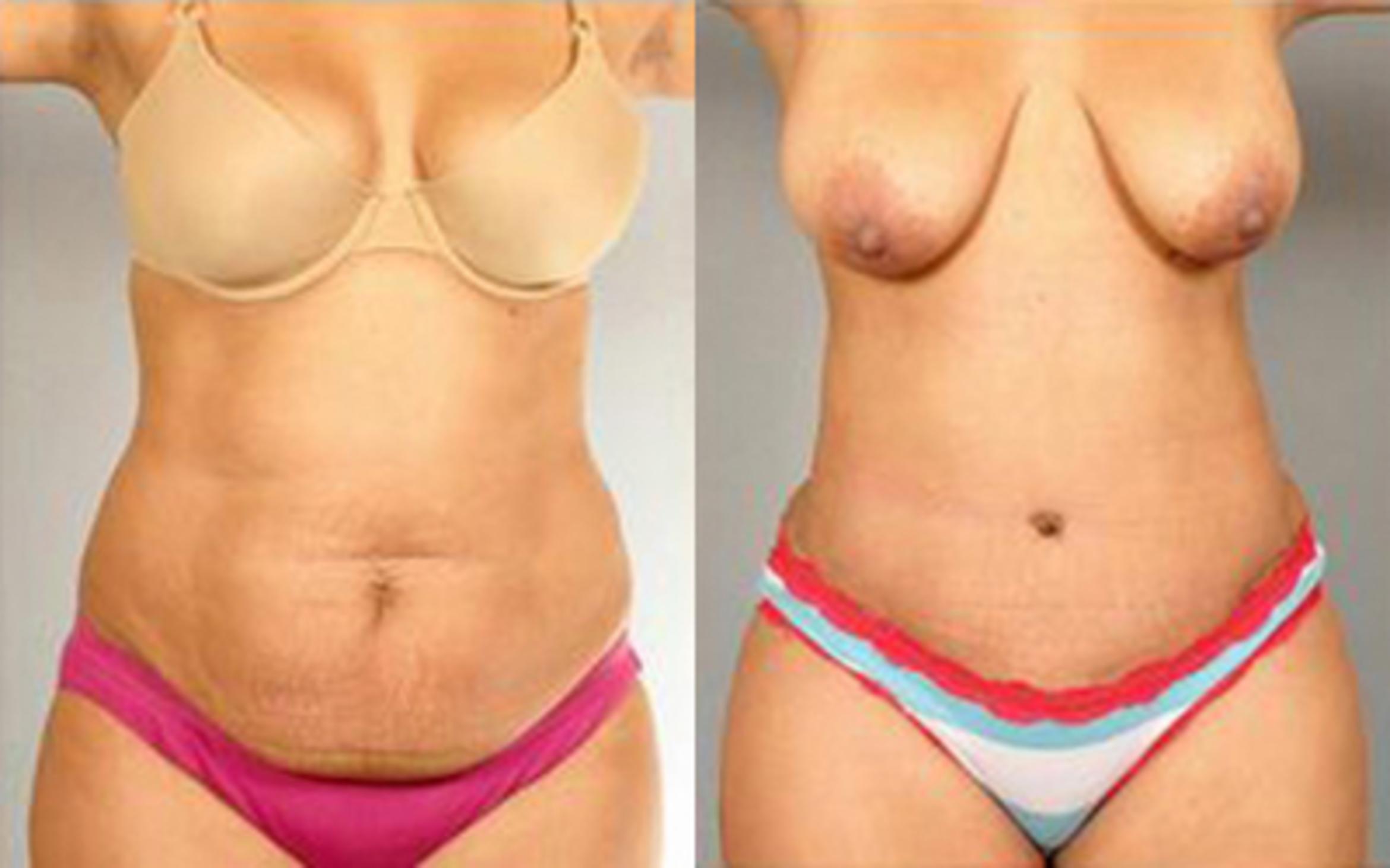 Before & After Tummy Tuck Case 66 View 1 View in Houston, TX