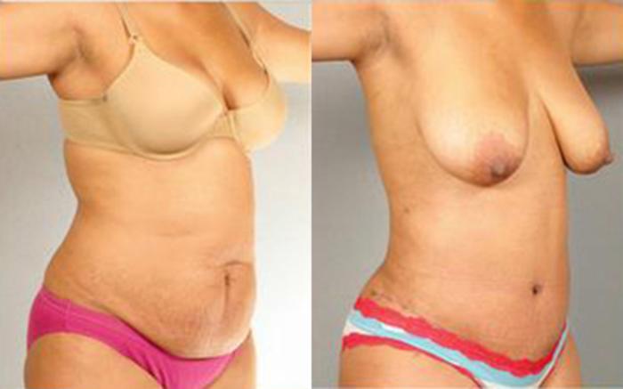 Before & After Tummy Tuck Case 66 View 2 View in Houston, TX