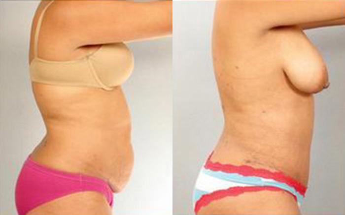 Before & After Tummy Tuck Case 66 View 3 View in Houston, TX