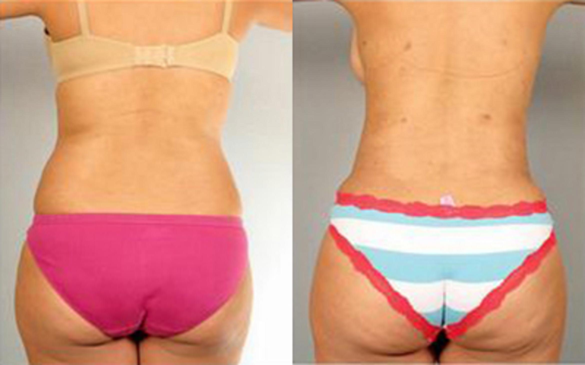 Before & After Tummy Tuck Case 66 View 4 View in Houston, TX