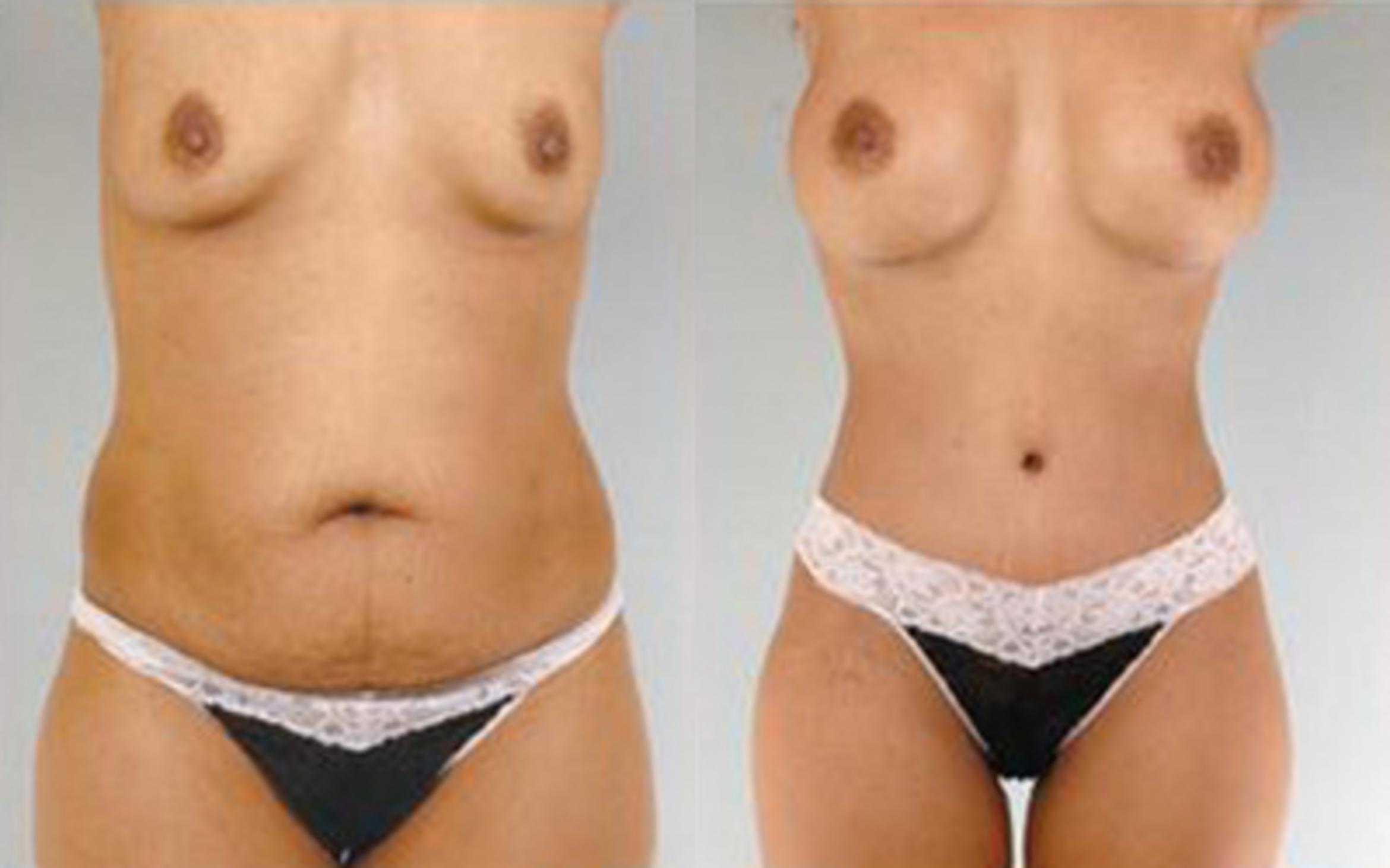 Before & After Tummy Tuck Case 68 View 1 View in Houston, TX