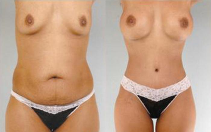 Before & After Tummy Tuck Case 68 View 1 View in Houston, TX