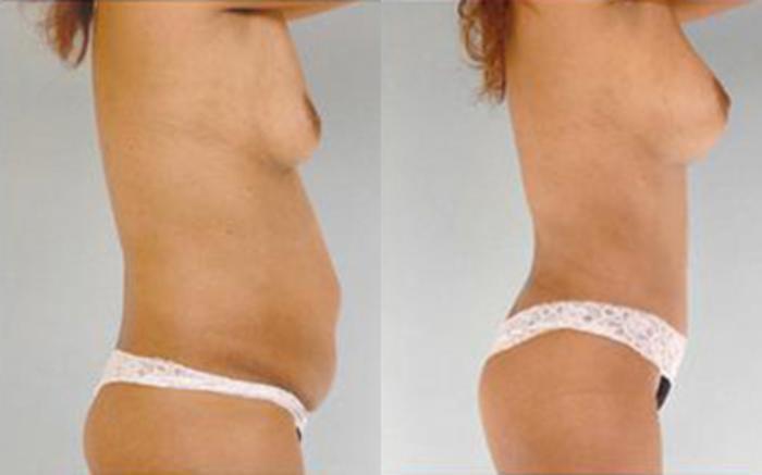 Before & After Tummy Tuck Case 68 View 3 View in Houston, TX