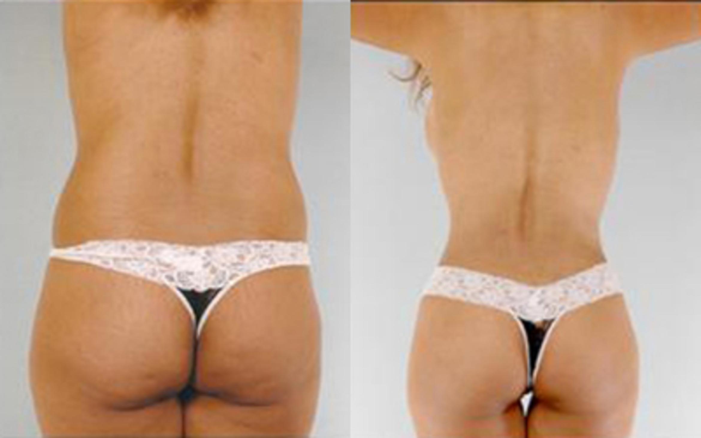 Before & After Tummy Tuck Case 68 View 4 View in Houston, TX