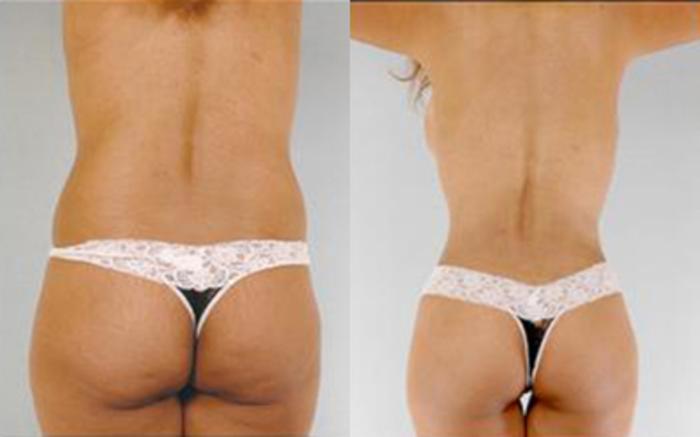 Before & After Tummy Tuck Case 68 View 4 View in Houston, TX