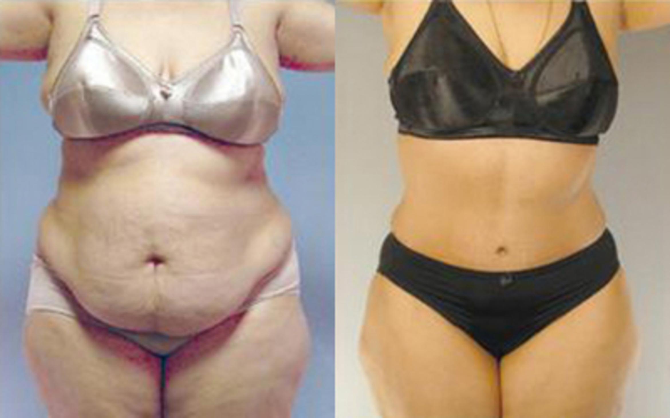 Before & After Tummy Tuck Case 69 View 1 View in Houston, TX