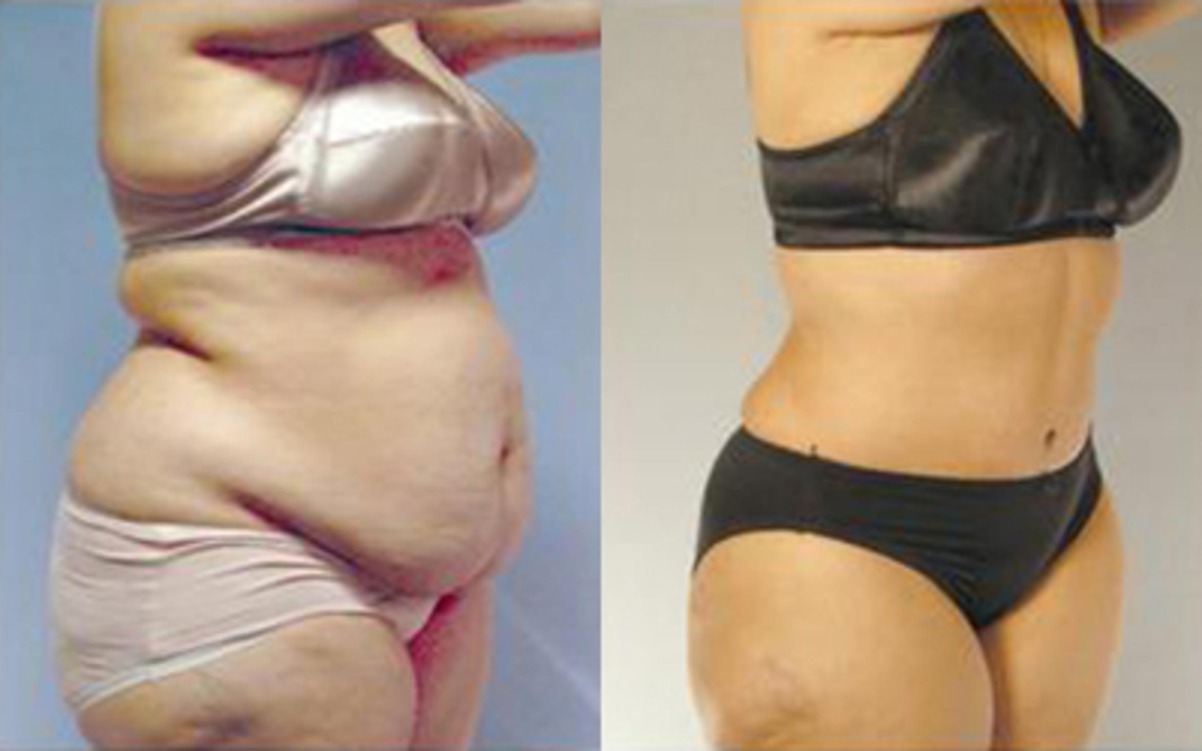Before & After Tummy Tuck Case 69 View 2 View in Houston, TX