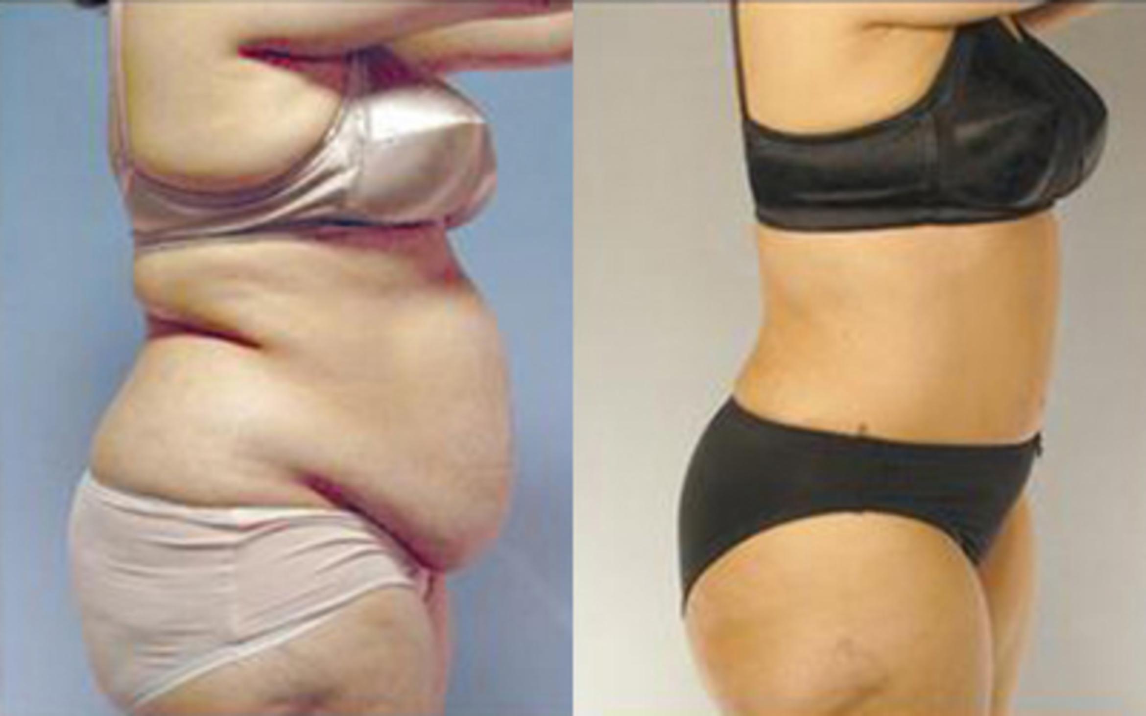 Before & After Tummy Tuck Case 69 View 3 View in Houston, TX