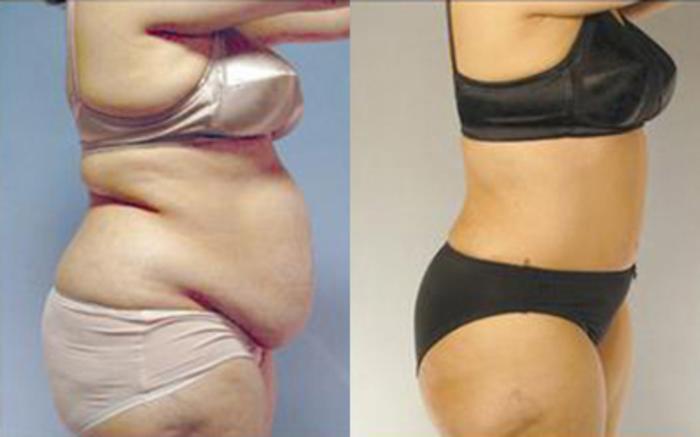 Before & After Tummy Tuck Case 69 View 3 View in Houston, TX