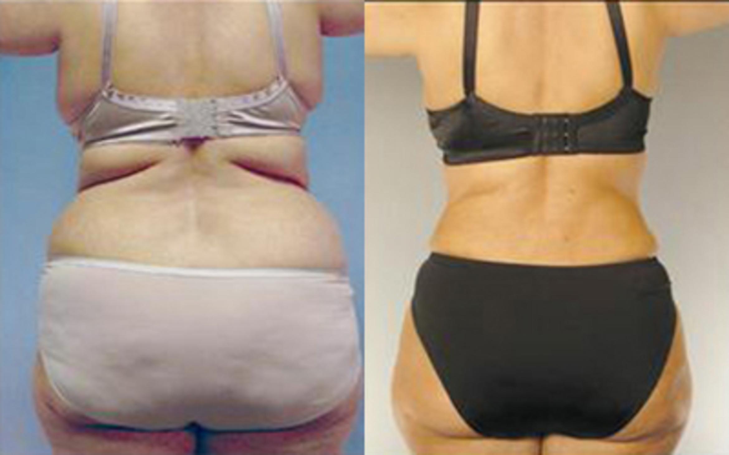 Before & After Tummy Tuck Case 69 View 4 View in Houston, TX