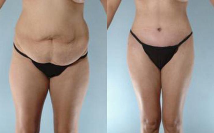 Before & After Tummy Tuck Case 7 View 1 View in Houston, TX
