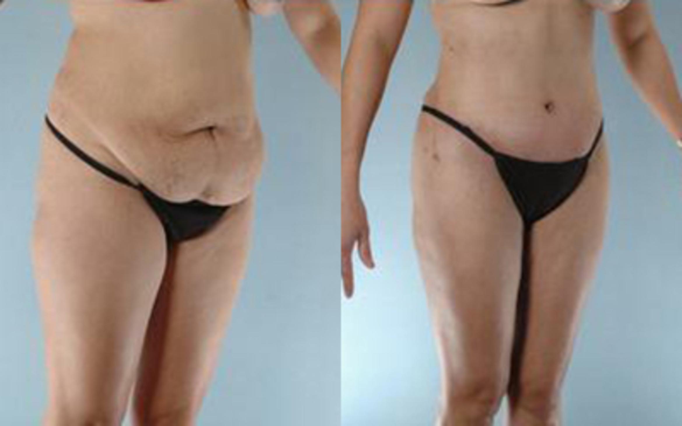 Before & After Tummy Tuck Case 7 View 2 View in Houston, TX